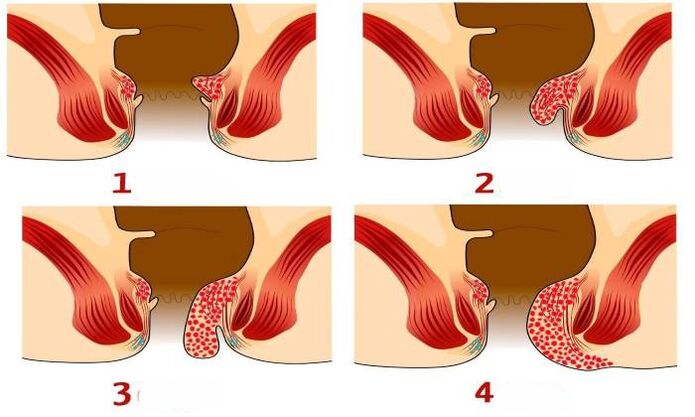jak wyglądają hemoroidy na różnych etapach
